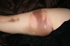Self-Treatment for Hamstring Injury with BVT (Bee Venom Therapy)